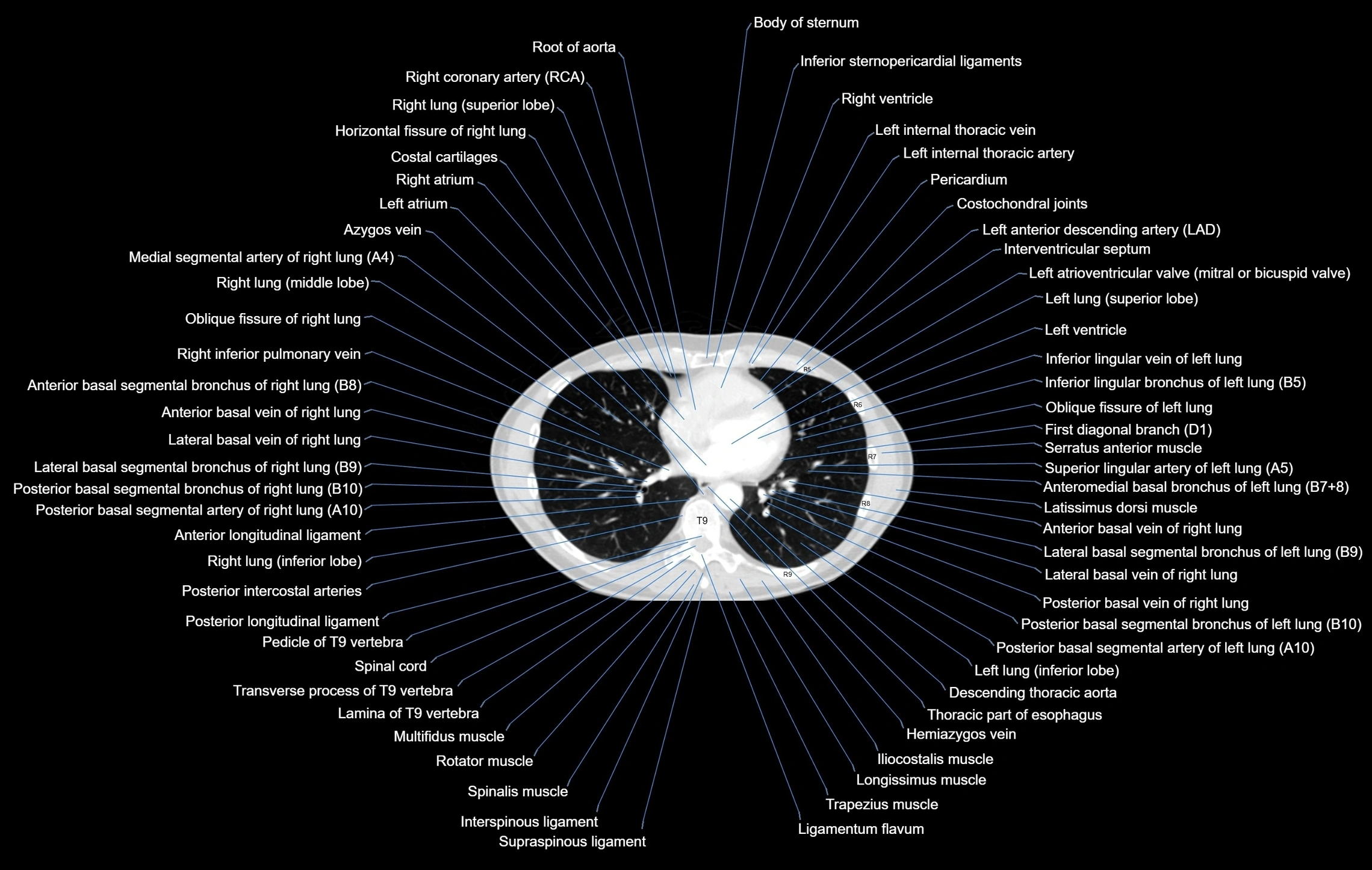 CT chest (thorax) lung window window labelled axial cross sectional anatomy radiology image-00077.webp